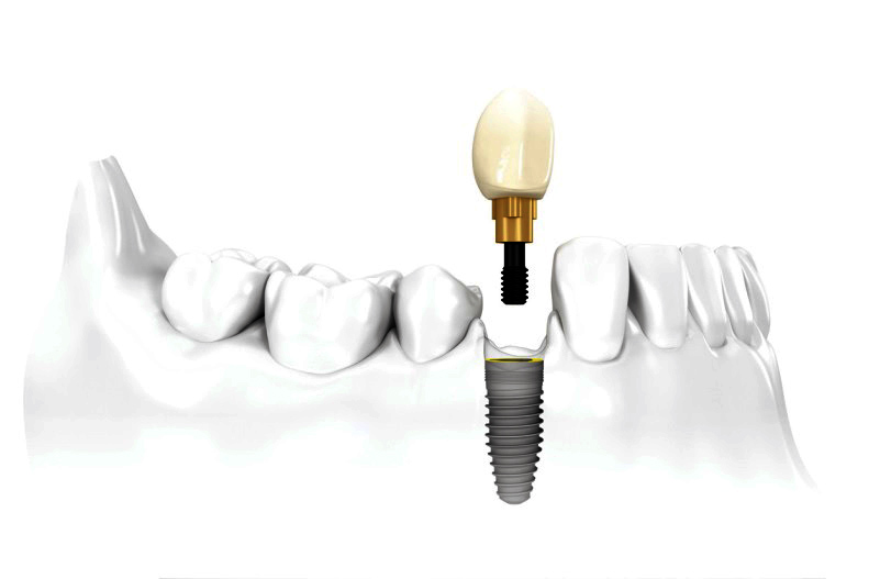 Установка простого импланта в Кишиневе в случае потери одного зуба