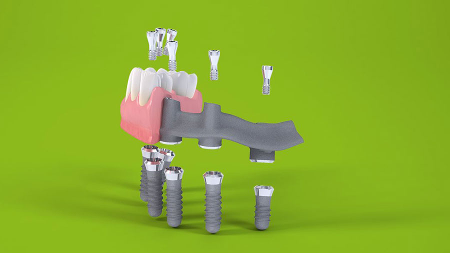 Implant dentar All-on-6