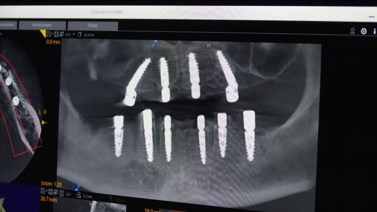 Implanturi dentare in Chisinau – o solutie moderna