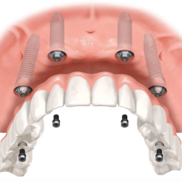 Виды зубных имплантов в Кишиневе классификация и описание