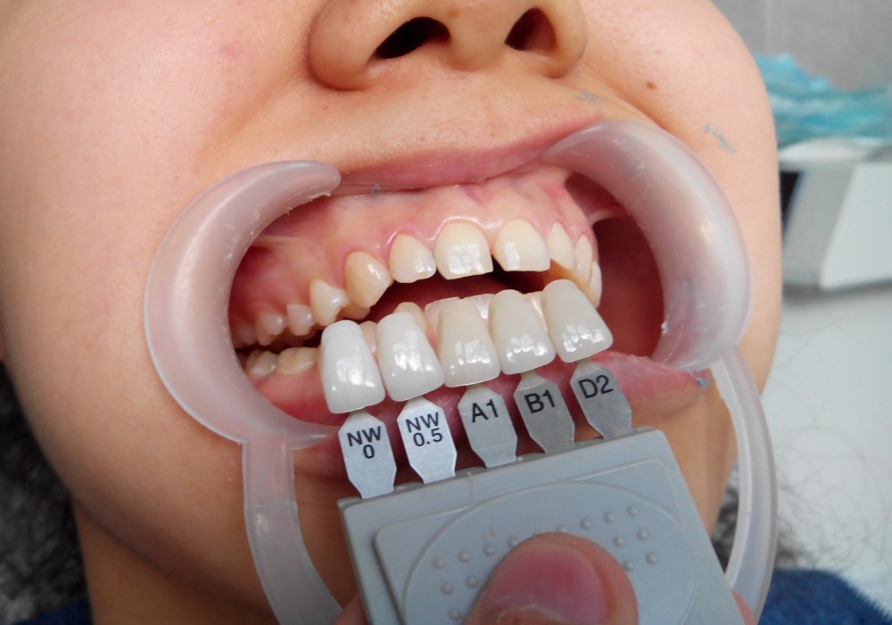 Indicatii pentru implant dentar in Balti / in Chisinau