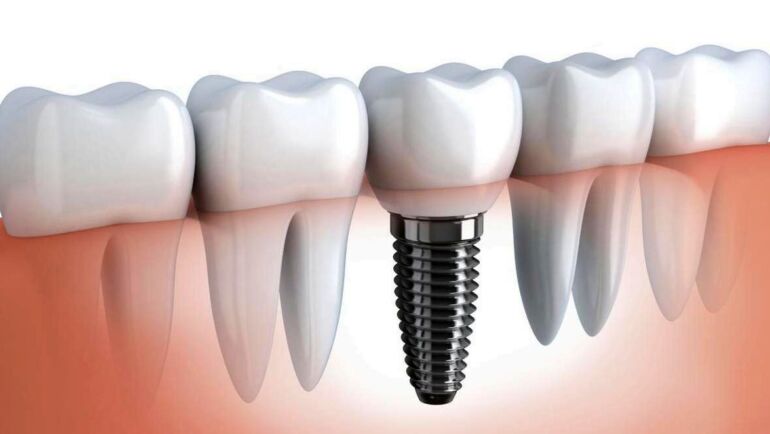 Prices for dental implants surgery on a turnkey basis in Moldova