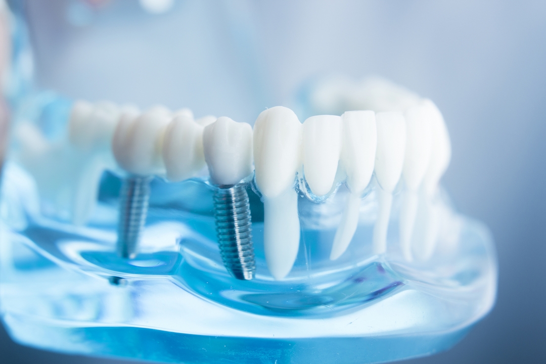 Dental implant surgery in Moldova – prices, quality, recommendations