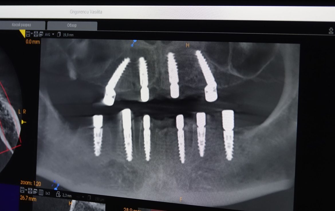 Implanturile dentare la implant.md: Soluția modernă pentru o dantură completă
