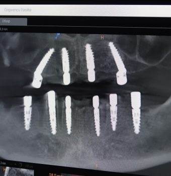 Implanturile dentare la implant.md: Soluția modernă pentru o dantură completă