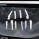 Implanturile dentare la implant.md: Soluția modernă pentru o dantură completă
