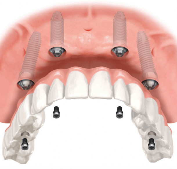 Tipuri de implanturi dentare: Clasificare și caracteristici la implant.md