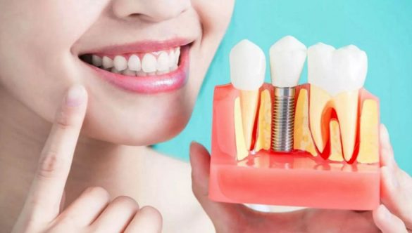 De ce implantul dentar este cea mai sigură și estetică soluție de protezare?