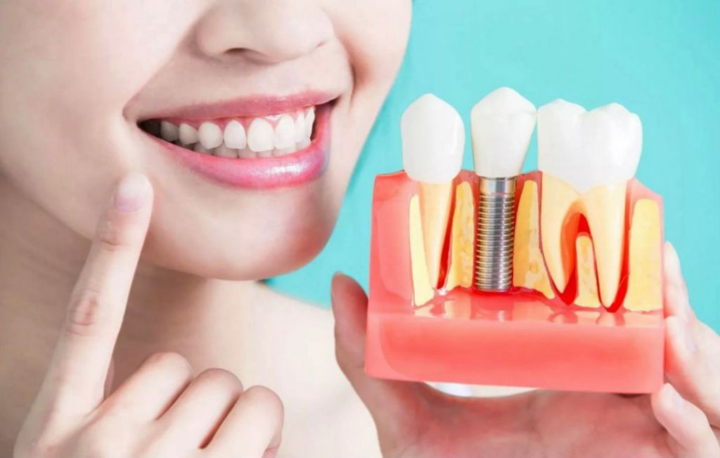 De ce implantul dentar este cea mai sigură și estetică soluție de protezare?