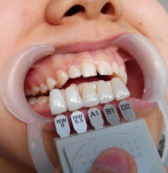 Indicații pentru implantul dentar: când este necesară reabilitarea orală?