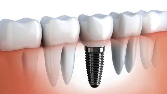 Prețuri pentru implanturi dentare „la cheie” la clinica implant.md din Bălți