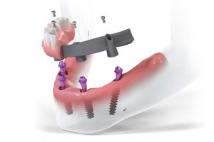 Reabilitarea orală totală: Protocoalele All-on-4 și All-on-6 la implant.md în Bălți