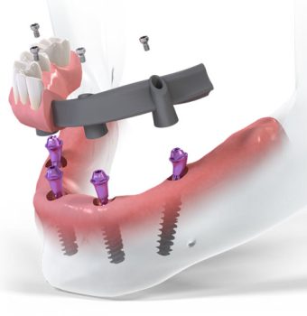 Reabilitarea orală totală: Protocoalele All-on-4 și All-on-6 la implant.md în Bălți