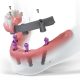 Reabilitarea orală totală: Protocoalele All-on-4 și All-on-6 la implant.md în Bălți