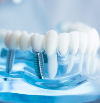 Implant dentar în Bălți: Calitate, precizie și soluții personalizate